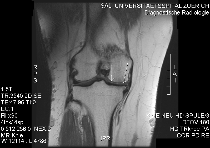 MRI of a knee showing completely missing articular cartilage at the medial femorotibial compartment with the lateral compartment still intact — end-stage medial cartilage loss.