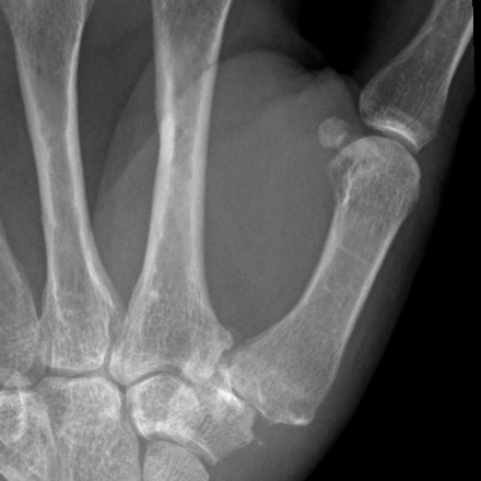 Zoomed PA X-ray of the thumb CMC joint showing joint space narrowing and sclerosis between the first metacarpal base and the trapezium.