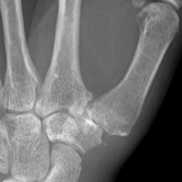 Zoomed X-ray of the thumb CMC joint showing joint-space narrowing and sclerosis from basal-joint arthritis