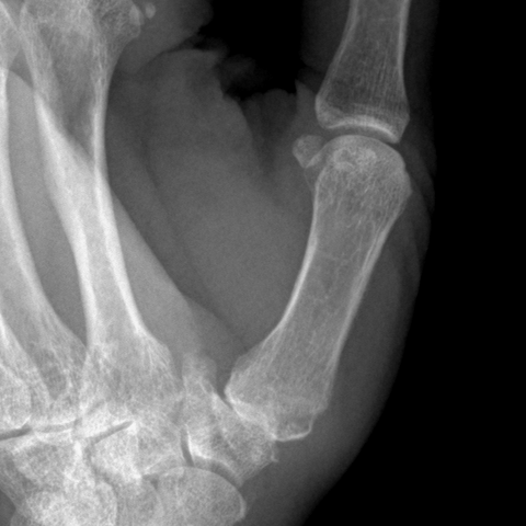 Zoomed oblique X-ray of the thumb CMC joint showing dorsal subluxation of the first metacarpal on the trapezium and peripheral osteophytes.