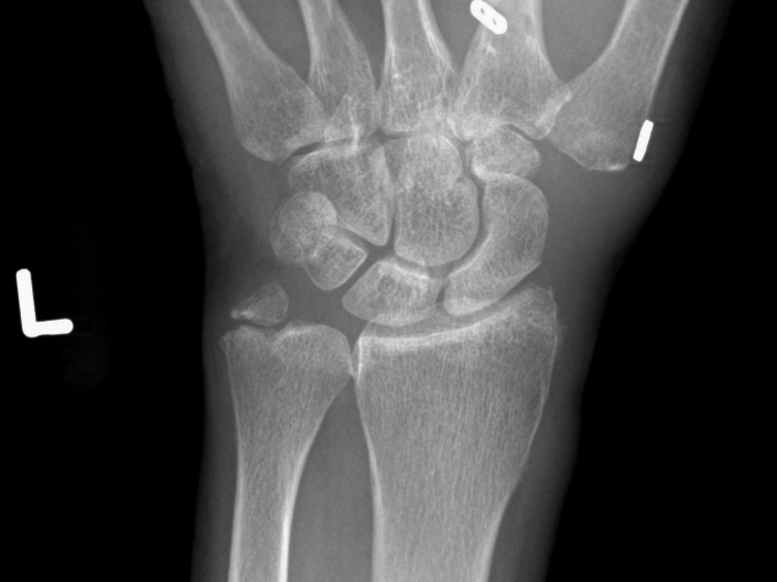 Postoperative PA X-ray of a thumb CMC arthroplasty