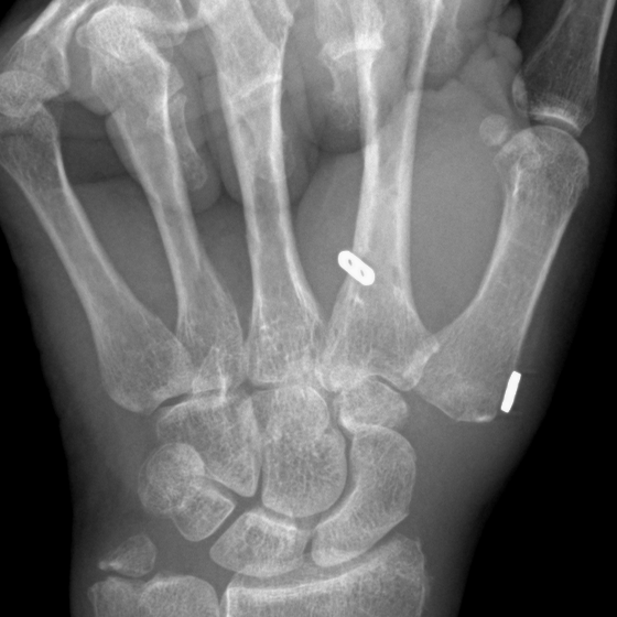 Postoperative X-ray zoomed on the reconstructed thumb base — trapezium excised and suture anchors visible from the soft-tissue suspension.