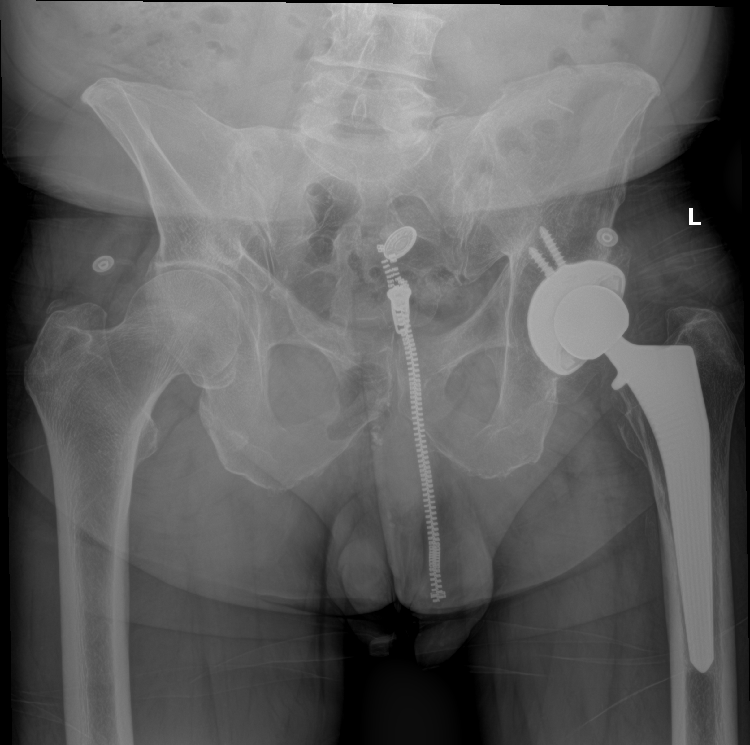 Postoperative AP pelvis X-ray of a total hip replacement